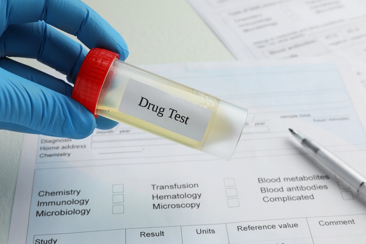A gloved hand holds a container with the inscription: DRUG TEST with a urine sample above the medical form on the table, various methods are used to detect kratom in the body, such as special blood and urine tests